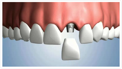 implant dentaire la teste